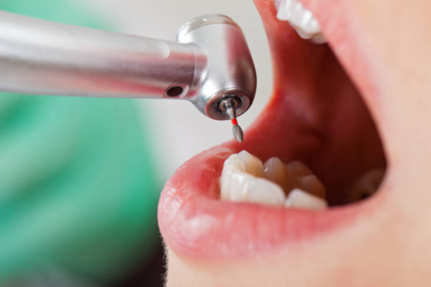 Best Broken or Chipped Tooth Repair in Orchard Mesa, CO